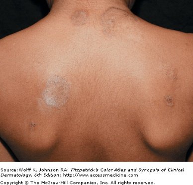 Upper back with several round scaly plaques of varying size, each with a raised active border and a paler clearer center.