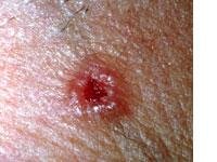 Small round lesion on pale skin with a translucent raised rolled border and a depressed crusted red center.