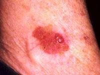 Raised red-brown plaque on sun-damaged skin with an irregular scaling crusted surface and a small central erosion.