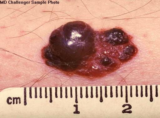 A large irregular lesion on skin with a raised glossy near-black nodular portion, a ragged notched dark red-brown area beside it, and a centimeter ruler below showing it spans over two centimeters.