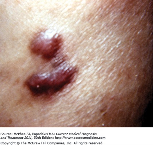 Two adjacent raised firm plaques of deep purple-red color on otherwise normal skin.