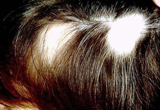 Scalp with dark hair parted to show two smooth well-circumscribed round bald patches with no scaling or redness.