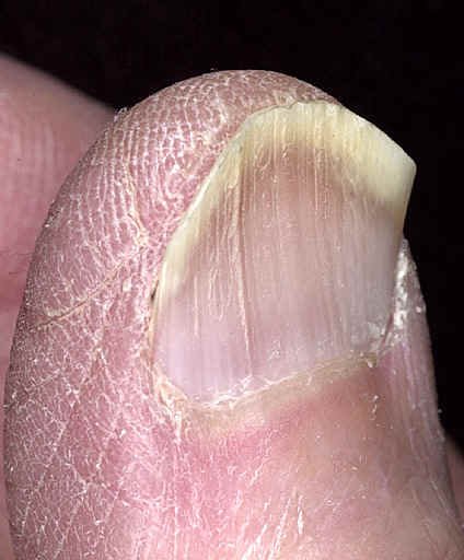 Fingertip with a nail whose plate is thinned and curves upward at the edges into a concave spoon shape.