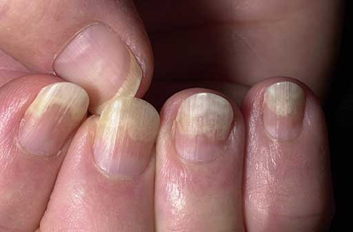Four fingernails with the outer portions separated from the nail bed, appearing opaque yellow-white against the pink attached proximal nail.