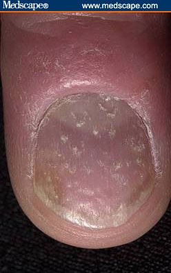 A single fingernail whose surface is dotted with numerous small shallow depressions scattered irregularly across the plate.