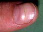 A fingernail crossed by a single pale line running side to side across the plate, parallel to the nail base.