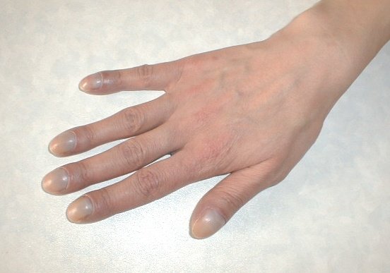 Back of a hand with all four fingertips broadened and rounded, the nails curving over bulbous ends.
