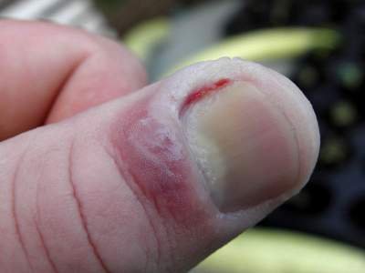 Thumb with the skin of the nail fold swollen, shiny and deep red, with a small streak of blood at the nail margin.
