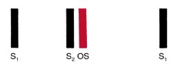 Strip of bars labeled S1, S2 with a red bar labeled OS, for opening snap, immediately after it, then S1.