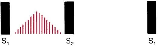 Waveform between S1 and S2 in which red lines rise to a peak in mid-systole and fall away before S2, with a gap at each end.