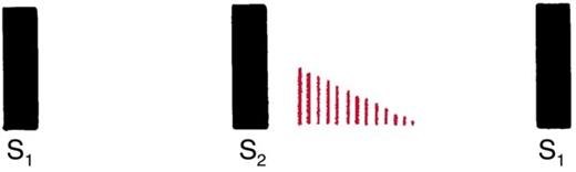 Waveform in which a shorter band of red lines starts a little after S2 and tapers away in mid-diastole.
