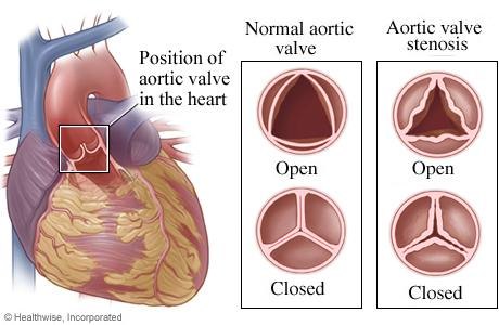 Illustration of the heart with the aortic valve position marked, and two insets comparing a normal three-leaflet aortic valve open and closed with a stenotic valve whose thickened leaflets open only to a narrow slit.