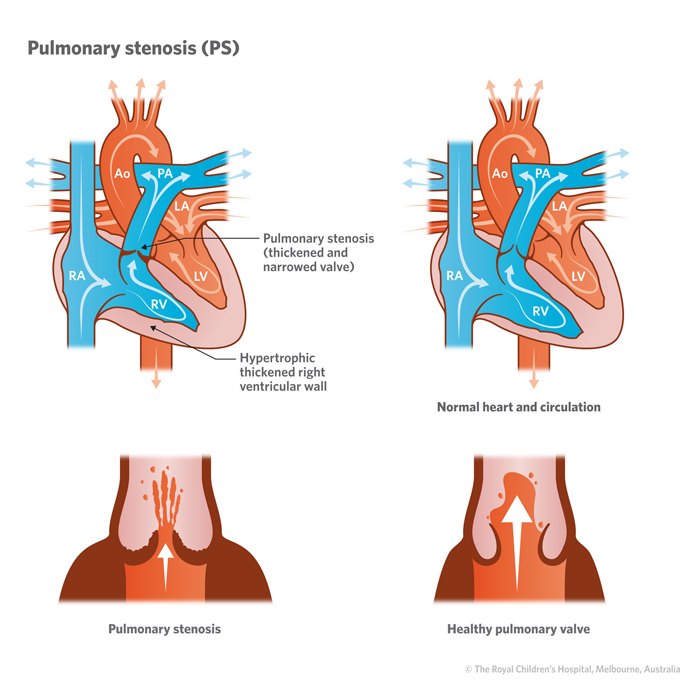 Paired diagrams of the heart and great vessels comparing a thickened, narrowed pulmonary valve with a hypertrophied right ventricular wall against a normal heart and healthy pulmonary valve.