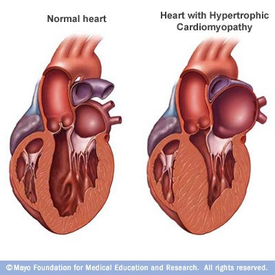 Two cutaway hearts side by side, a normal heart and one with hypertrophic cardiomyopathy showing a markedly thickened interventricular septum and left ventricular wall narrowing the outflow tract.