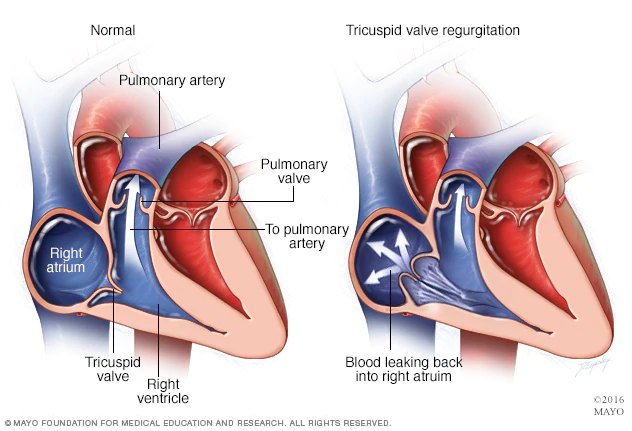 Two cutaway views of the right heart, one normal and one with tricuspid valve regurgitation showing arrows of blood leaking back from the right ventricle into the right atrium.