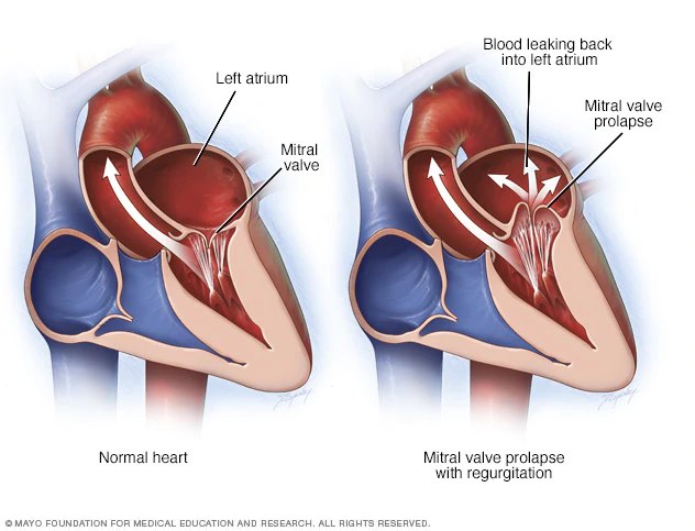 Two cutaway views of the left heart, one normal and one with mitral valve prolapse and regurgitation showing arrows of blood leaking back from the left ventricle into the left atrium.