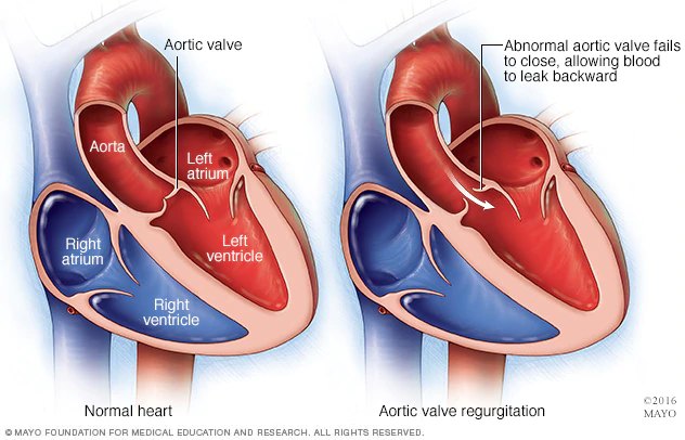 Two cutaway hearts, a normal heart and one with aortic valve regurgitation in which the abnormal aortic valve fails to close and blood leaks backward into the left ventricle.