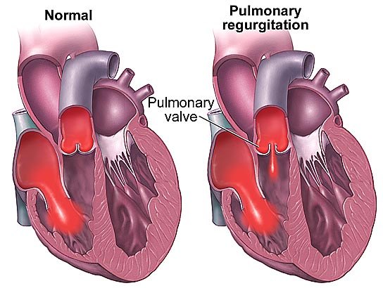 Two cutaway hearts, normal and with pulmonary regurgitation, showing a jet of blood leaking back through the pulmonary valve into the right ventricle.