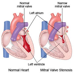 Two drawings comparing a normal mitral valve with a narrow mitral valve between the left atrium and left ventricle.
