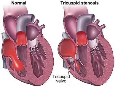 Two cutaway hearts, normal and with tricuspid stenosis, showing a narrowed tricuspid valve between the right atrium and right ventricle.