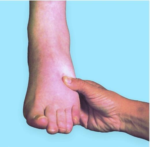 A thumb pressing firmly into the swollen top of a foot.