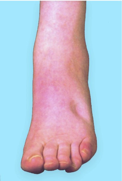 The same swollen foot after the thumb is removed, with a visible depression left in the skin.