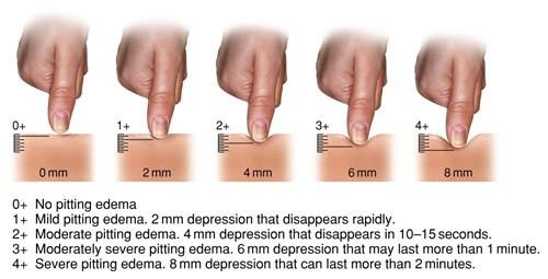 Five fingers pressing into skin at increasing depths labeled 0 to 4+ with 0, 2, 4, 6 and 8 millimeters, above a key describing each grade and how long the pit lasts.