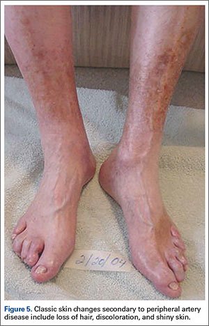 Both lower legs and feet showing shiny, hairless skin with patchy discoloration over the shins.