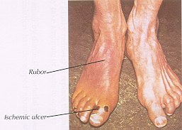 Two feet on a rough surface, one with a dusky red flush labeled rubor and a small dark ulcer on the tip of a toe labeled ischemic ulcer.