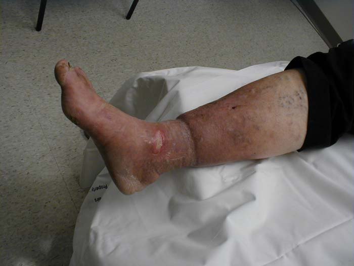 A lower leg and foot lying on a sheet, markedly swollen, with reddish-brown discoloration and a patch of broken skin above the ankle.