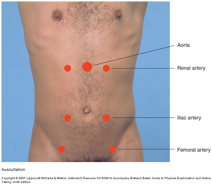 Abdomen of a supine man marked with red dots at the aorta in the upper midline, the renal arteries on either side of it, the iliac arteries beside the umbilicus, and the femoral arteries in each groin.