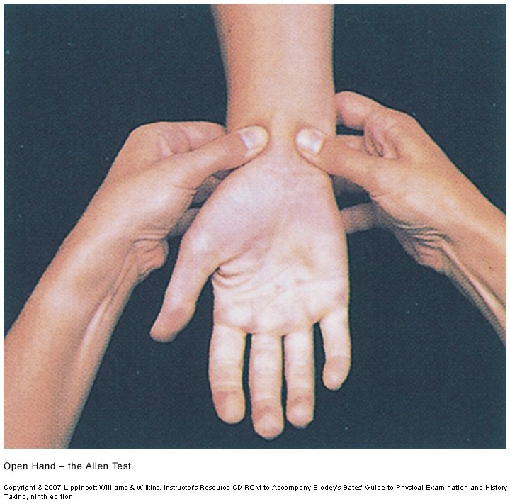 The patient's hand opened with the palm pale while both arteries are still compressed at the wrist.