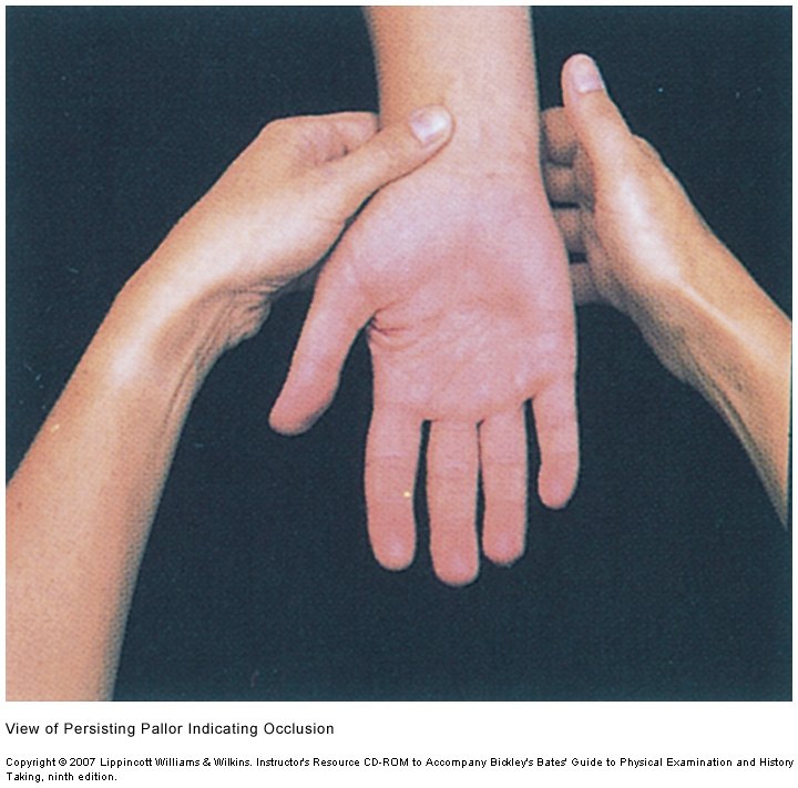 An opened palm that remains pale although pressure over one artery has been released.