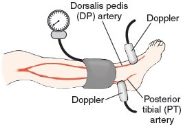 Drawing of a lower leg with a blood pressure cuff above the ankle and Doppler probes over the dorsalis pedis and posterior tibial arteries.