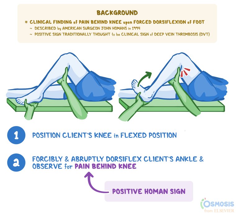 Illustration of a patient's leg with the knee flexed while an examiner abruptly dorsiflexes the ankle, with numbered steps and pain marked behind the knee as a positive sign.