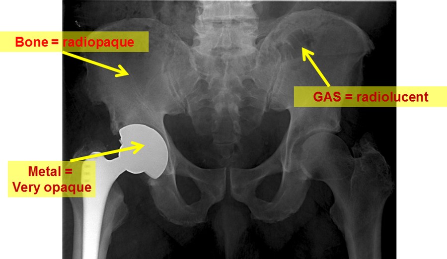 Pelvic radiograph with a metal hip prosthesis, annotated with three yellow labels: bone equals radiopaque, gas equals radiolucent, and metal equals very opaque.