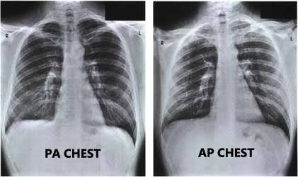 Two chest radiographs side by side, labeled PA CHEST and AP CHEST. The heart on the AP film is visibly larger relative to the thorax than on the PA film.