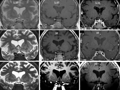 Nine brain magnetic resonance images in a three by three grid. Rows are 1.5 Tesla, 3 Tesla and 7 Tesla from top to bottom. The left column is T2-weighted and the middle column is T1-weighted; cerebrospinal fluid in the ventricles is bright in the left column and dark in the middle column.