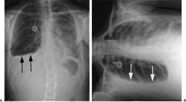 Two chest radiographs of the same patient. On the upright film, arrows point to blunting at the costophrenic angle; on the lateral decubitus film, arrows point to fluid that has layered out along the dependent chest wall.