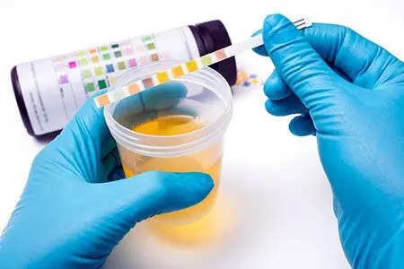 Gloved hands holding a urinalysis reagent strip beside a specimen cup of urine, comparing the strip's colored pads against the printed color chart on the reagent bottle.