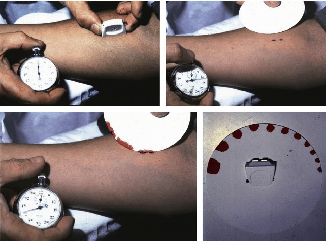 Four photographs of a bleeding time test on the forearm: a spring-loaded device makes small horizontal cuts, blood is blotted onto filter paper at intervals while a stopwatch runs, and the pattern of blotted spots fades as bleeding stops.