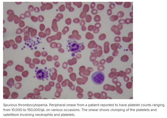 Peripheral blood smear showing clumps of platelets and neutrophils ringed by platelets, in a patient whose automated platelet count was reported as low.