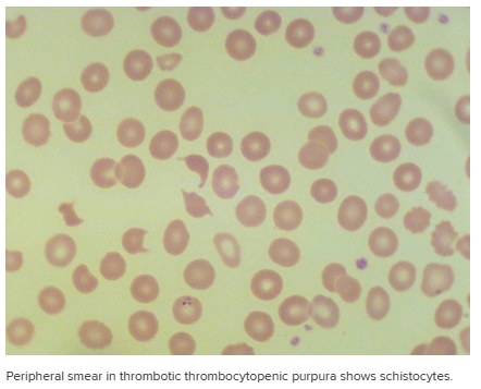 Blood smear in thrombotic thrombocytopenic purpura with several schistocytes, helmet-shaped and triangular red cell fragments.