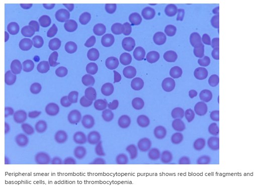 Blood smear in thrombotic thrombocytopenic purpura showing fragmented red cells and basophilic cells with few platelets.
