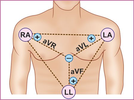 Torso diagram with electrodes at right arm, left arm and left leg, showing the augmented leads aVR, aVL and aVF each drawn from one limb electrode toward a central negative pole.