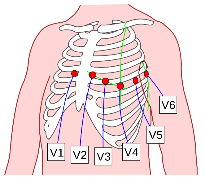 Diagram of the rib cage showing the six chest electrodes V1 to V6 placed from the right of the sternum across to the left side of the chest.