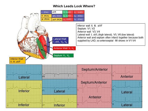 Chart titled Which Leads Look Where, showing a heart with the inferior wall, septum, anterior wall and lateral wall colored, a legend listing inferior wall II, III and aVF, septum V1 and V2, anterior wall V3 and V4, lateral wall I, aVL, V5 and V6, and a 12-lead layout with each lead shaded by the wall it views.