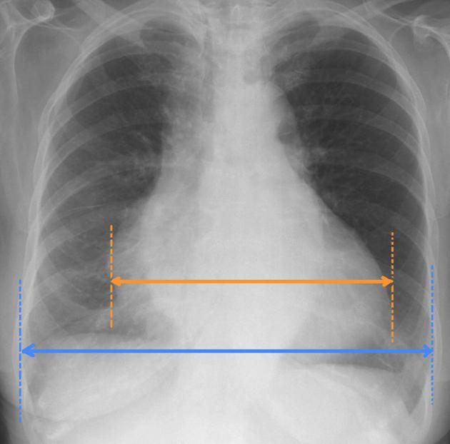Posteroanterior chest radiograph with an orange line across the widest part of the cardiac silhouette and a longer blue line across the widest internal diameter of the thorax.
