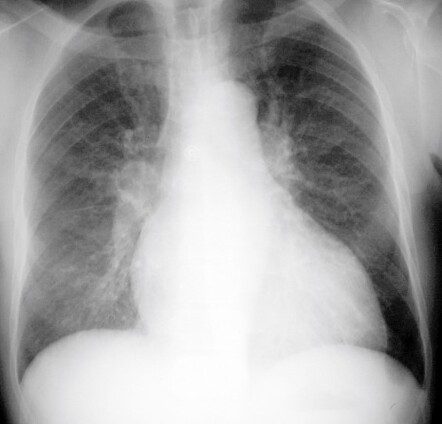 Posteroanterior chest radiograph with prominent, enlarged vascular markings in the upper zones of both lungs.